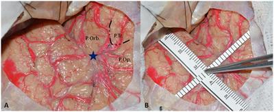 The anterior sylvian point as a reliable landmark for the anterior temporal lobectomy in mesial temporal lobe epilepsy: technical note, case series, and cadaveric dissection